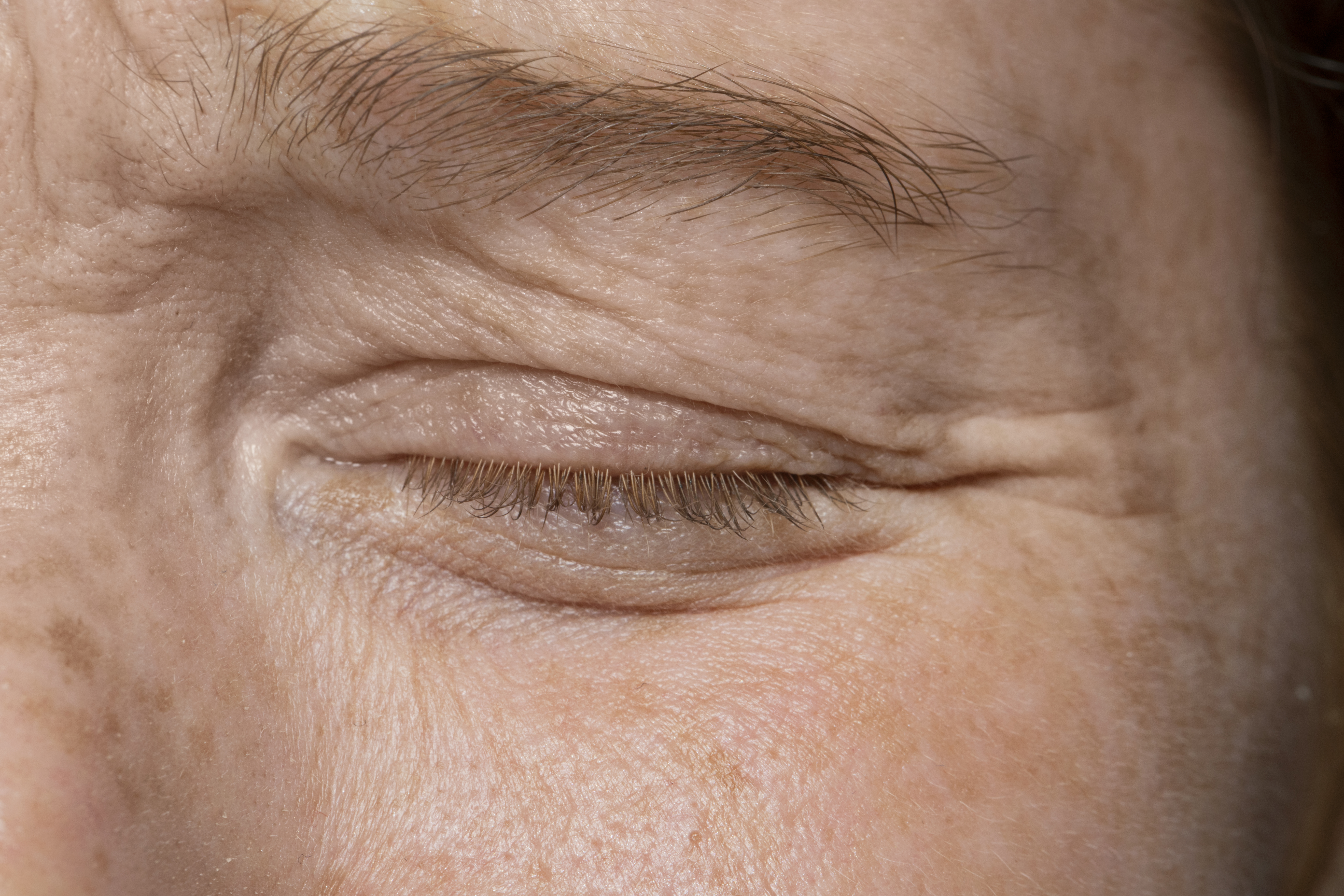 Blefaroplastia: O que você precisa saber